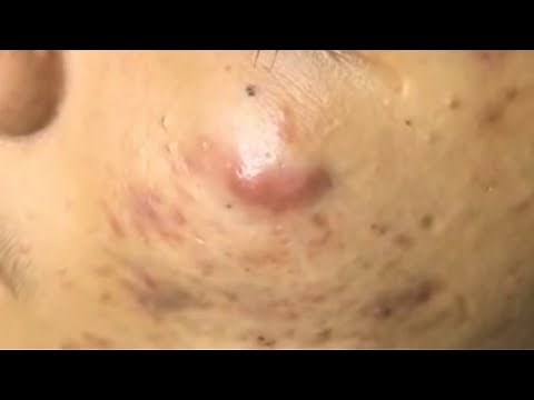 LARGE Blackheads Removal - Satisfying Blackhead 2019