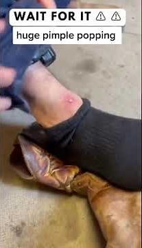 Cystic Acne Removal & Inflammatory Acne