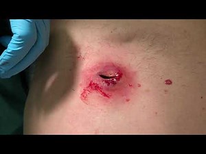 Infected Sebaceous Cyst