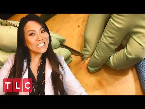 Popping Hair Cysts From a Patient's Abdomen! | Dr. Pimple Popper: This is Zit