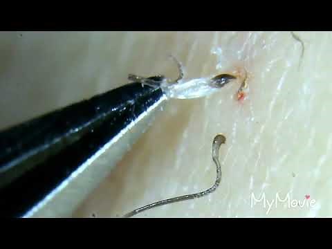 Satisfying Plucking and Slimy Ingrown Hair Roots