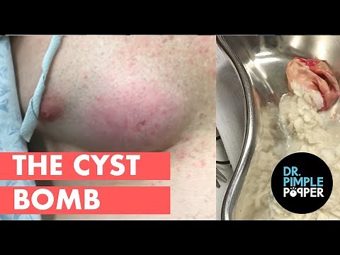The Cyst Bomb