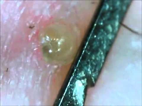 Volcanic Cyst Eruption 2015