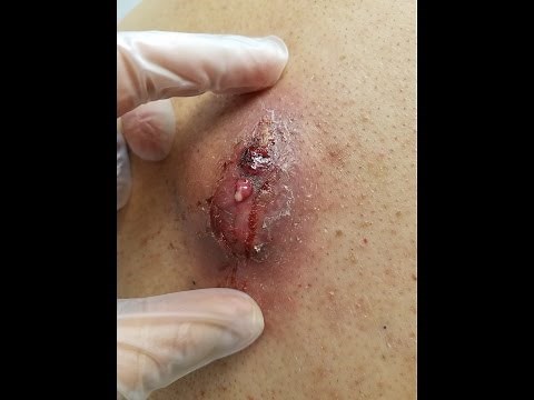 HD Graphic Massive Back Abscess Drainage Step by Step (Medical Education & Training)