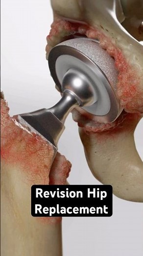 Revision Hip Replacement (3D Animation)