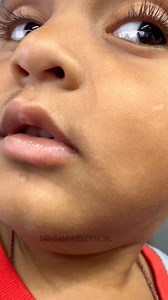 2.1M views · 1K reactions | Pityriasis Alba #drimranpatel | Dr Imran Patel | Facebook