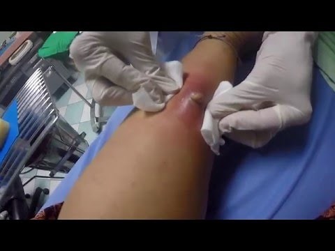 POPPING bug bite infection abscess