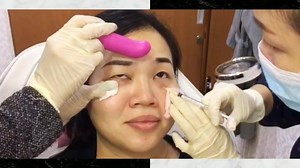 Dr Kee Yong Seng of Premier Clinic performed Mesolipo Fat Melting injection for eyebag reduction. The upper and lower eyelids are composed of skin, muscle and fat. The cause of eyebags is usually fat. As we get older, the skin starts to wrinkle and sag, and fat starts drooping. This causes the appearance of eyebags. Eyebags make a person look older and tired. But it can be treated. Eyebag removal plastic surgery is a treatment option but there's other methods of treatment as well. MesoLipo Fat M