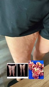8.5K views · 1.3K reactions | Lipedema isn’t just “stubborn fat” —...