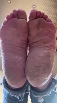Mature dry feet