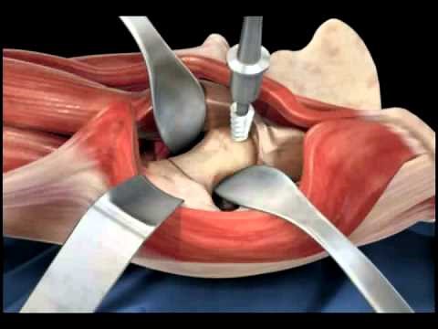Hip replacement surgery techniques - Dr. Scott Devinney
