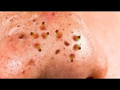 Horrible BLACKHEADS on nose removal