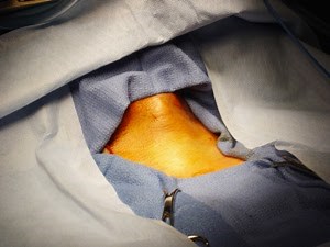 How a Tracheostomy is Performed Step-by-Step with Pictures