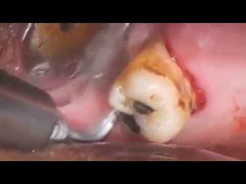 Abscess tooth removal | Tooth Abscess Extraction