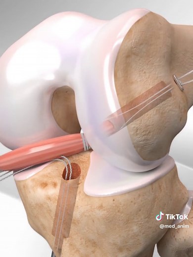 ACL Reconstruction Surgery Animation | 3D Illustration