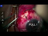 Double Tunnel Glaucoma Shunt with Mitomycin C, 2024 Update • Video • MEDtube.net
