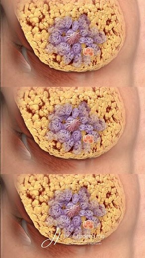 Diagnosing Gynecomastia