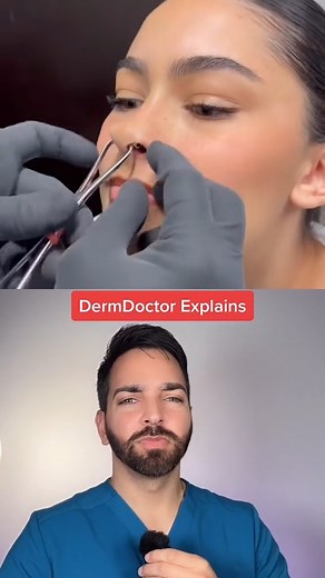 39K views · 258 reactions | septum piercing #dermdoctor #nasalpiercing #piercing #dermatologist | Doctorly | Facebook