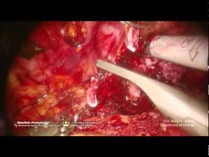 Robotic Prostate Cancer Surgery - Live High Definition Instructional Video for Patients