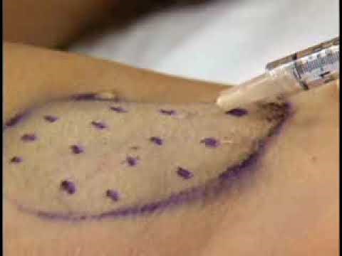 Botox for AXILLARY Hyperhidrosis (#armpits) Dr Dee Anna Glaser, International Hyperhidrosis Society©