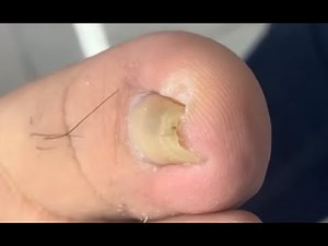 47K views · 479 reactions | Totally ingrown nail treatment | Ingrown toenails | Facebook