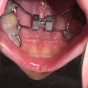 A young girl on her follow-up with an upper fixed expander, a lower...