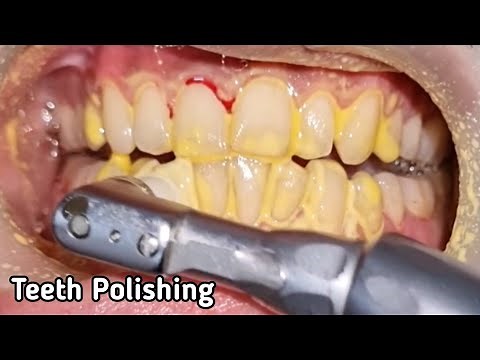 Teeth Polishing Before and After | Teeth Polish Treatment at The Dentist | Teeth Cleaning by doctor