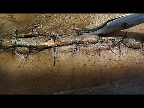 HOW TO REMOVE SURGICAL STITCHES... COMPLETE PROCESS EXPLAINED #drtusarofficial