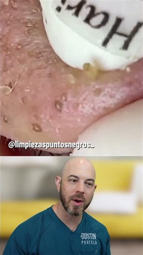 This Nose Won’t Heal Without Treatment — Rosacea Explained