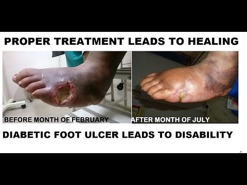 Diabetic foot ulcer (Charcot Foot): Charcot Restraint Orthotic Walker (CROW)
