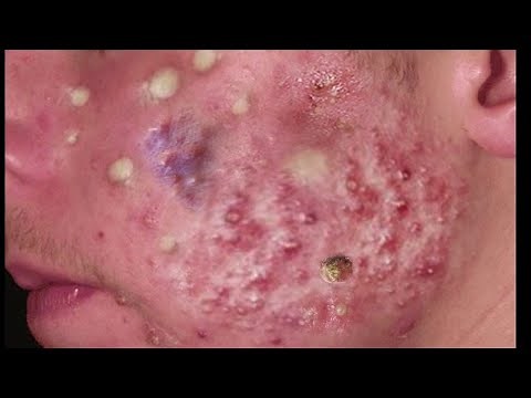 Big Deep Blackheads And Huge Cyst Pops - Pimple Popping Compilation!