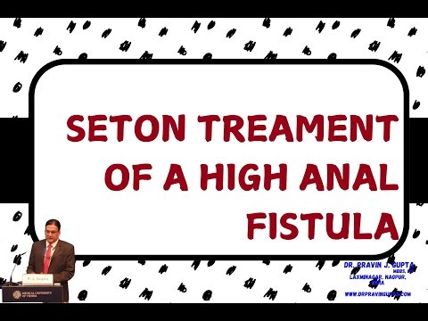 SETON TREATMENT OF A HIGH ANAL FISTULA उच्च गुदा फिस्टुला का सेटन उपचार