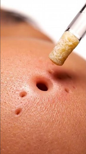 Pimple & Blackhead Extraction Vacuum Tool Demo