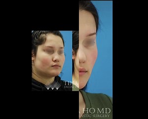 Buccal Fat Removal: Before and After