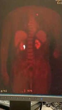 PET Scan Images: See How It Reveals Hidden Metabolic Activity #cancer