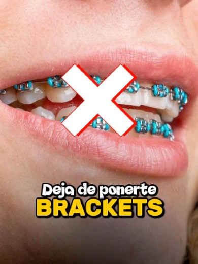 Brackets: razones para no usarlos solo por estética