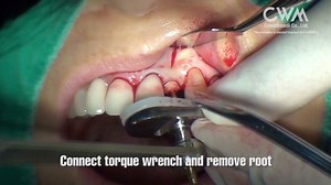 Cowell® Atraumatic Extraction Kit : Proving simplicity, safety and convenience to your daily practice | Cowellmedi