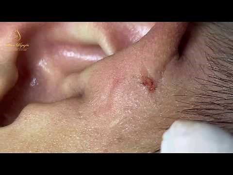 BLACKHEADS AND CYST on the ears (106) | Loan Nguyen