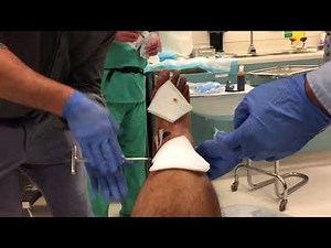 Severe Open Compound Fracture Fib-Tib External Fixator (Ex-Fix) Removal w/out Anesthetics