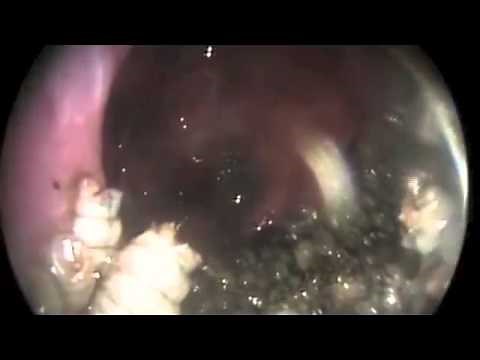 Nasal Myiasis | NEJM