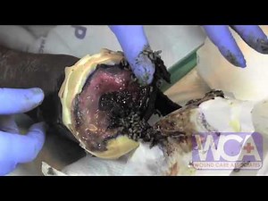 Maggot Therapy for Wounds - Wound Medicine Medcentris