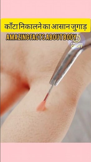 Amazing Syringe Trick to Remove a Splinter!