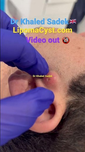 Massive blackhead extraction #skincare #blackheadremoval Dr Khaled Sadek