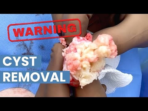 What's Inside This Huge Cyst (Cyst Removal Procedure) | CONTOUR DERMATOLOGY
