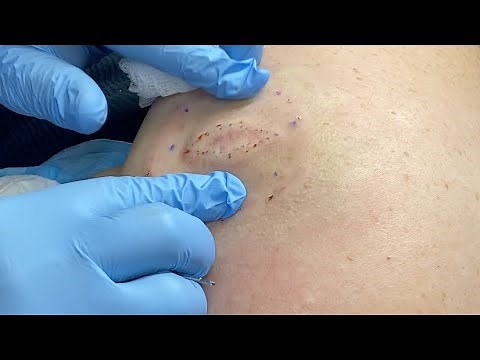 Removal of a large epidermal cyst on the shoulder