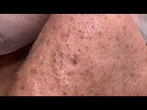 Satisfying Blackheads and Whiteheads Removal - Deep Pore Cleansing Techniques