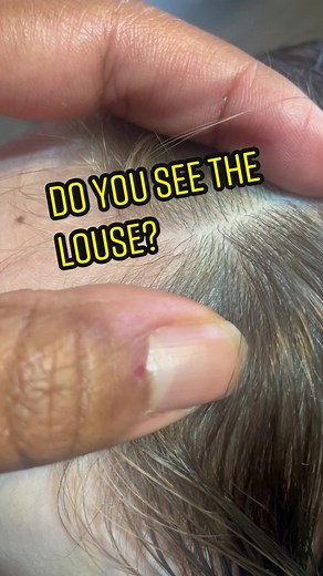Spotting and Removing Lice: A Comprehensive Guide to Lice Infestation