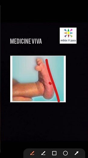 Medicine Rocker bottom feet trisomy 18 edward syndrome