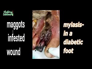 management of maggots infested diabetic wound/foot
