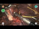 Robotic Right Lower Lobectomy CMR Versius • Video • MEDtube.net